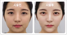잡티